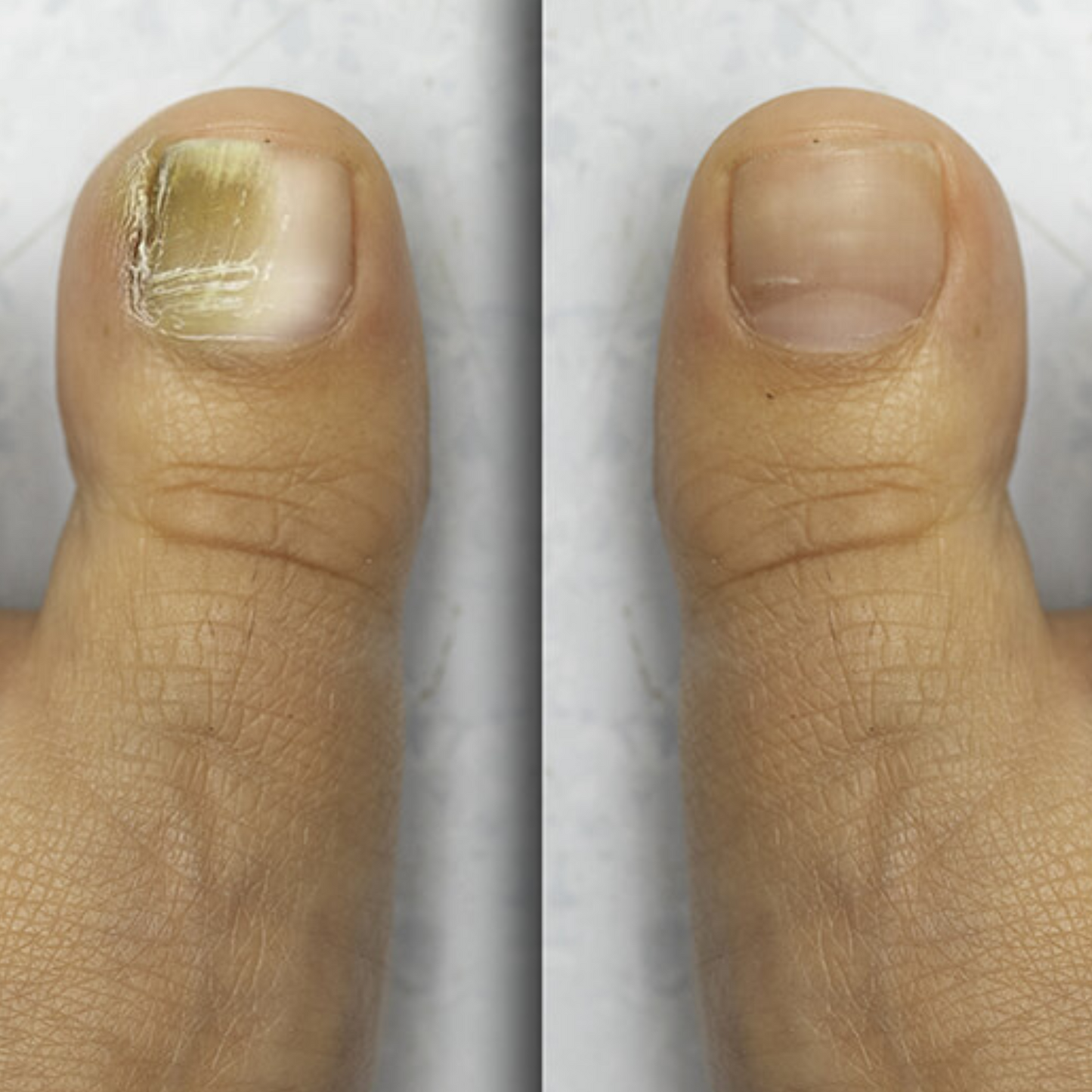 Antifungal Nail Pen